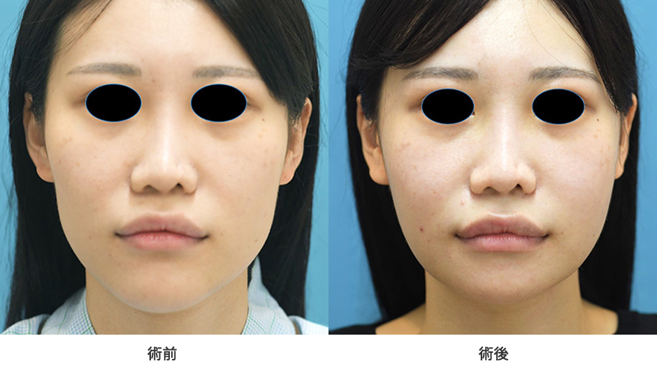 外板切除を併用した小顔治療