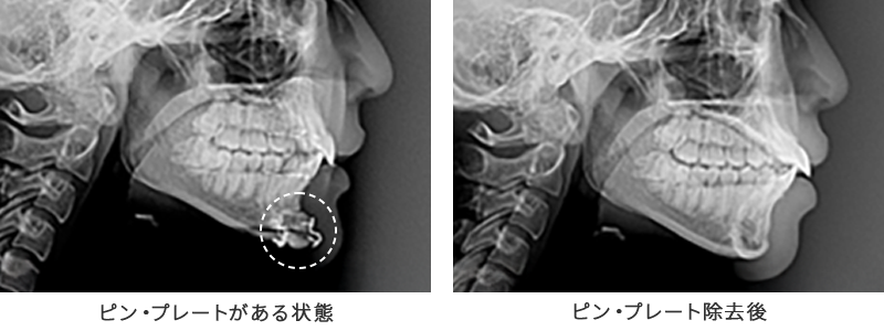 ピン・プレート除去は必須ではありません