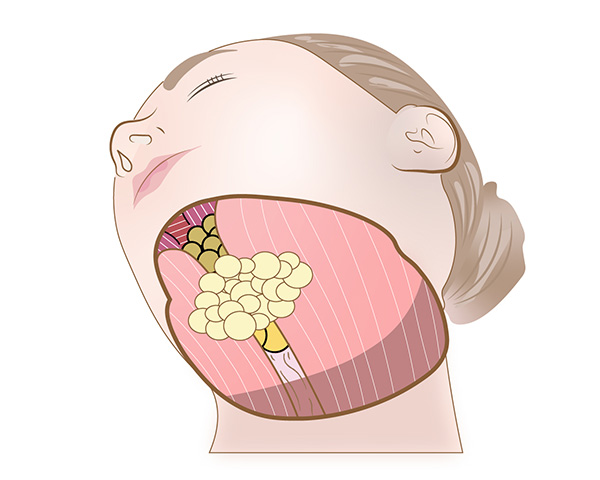 ２皮下脂肪の除去