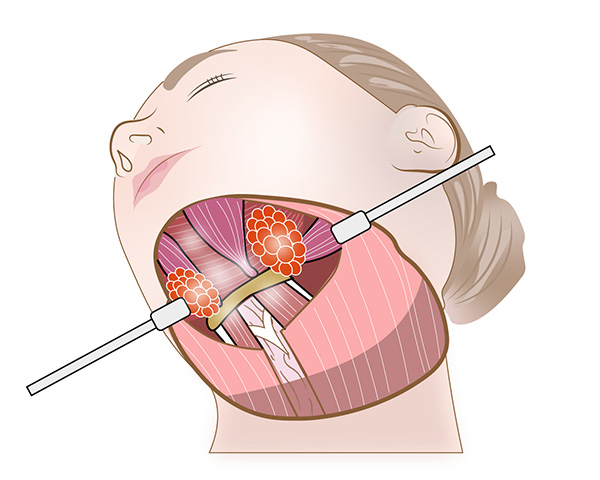 ５唾液腺の調整
