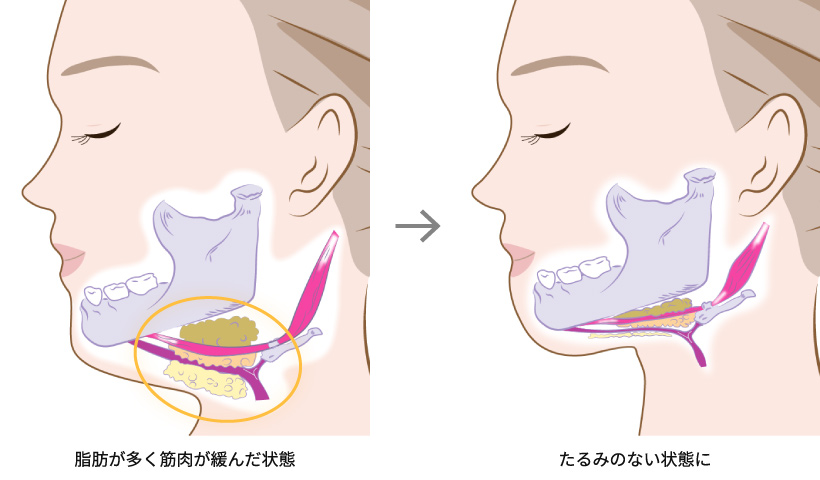 ペリカン手術でアプローチ可能な部位