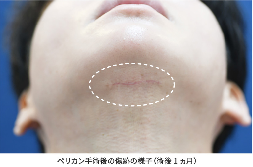 ペリカン手術後の傷跡の様子（術後1ヵ月）