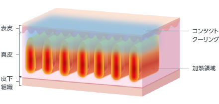 皮膚のたるみ・しわを選択的に引き締める