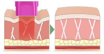 高周波による小顔・たるみ治療