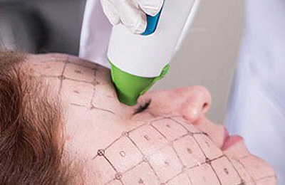 目元のたるみ・小じわ改善治療にもOK