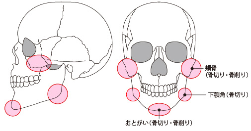 小顔形成術（小顔整形・輪郭3点）の種類