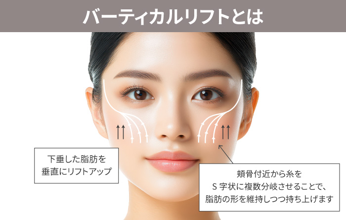バーティカルリフトとは
