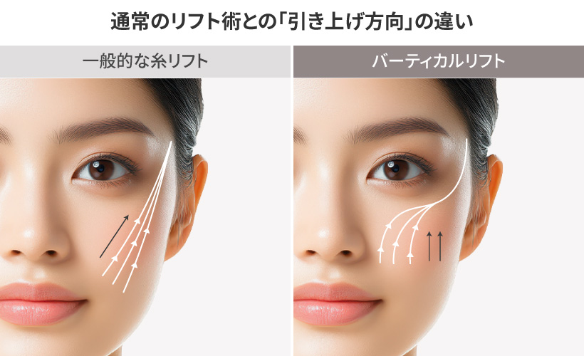 通常のリフト術との「引き上げ方向」の違い