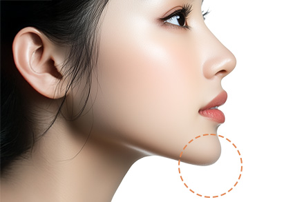 魔女顎手術（顎先のたるみ取り）とは