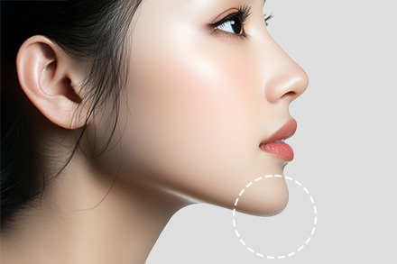 魔女顎手術(顎先のたるみ取り)