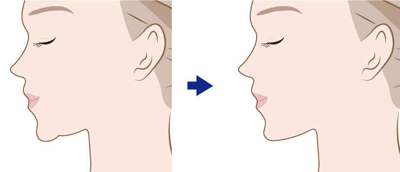 細く垂れ下がった顎先のたるみを除去