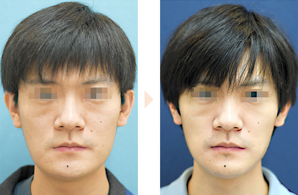 カスタマイズVライン形成（正面から見た角度のみ小顔に）の症例写真・ビフォーアフター