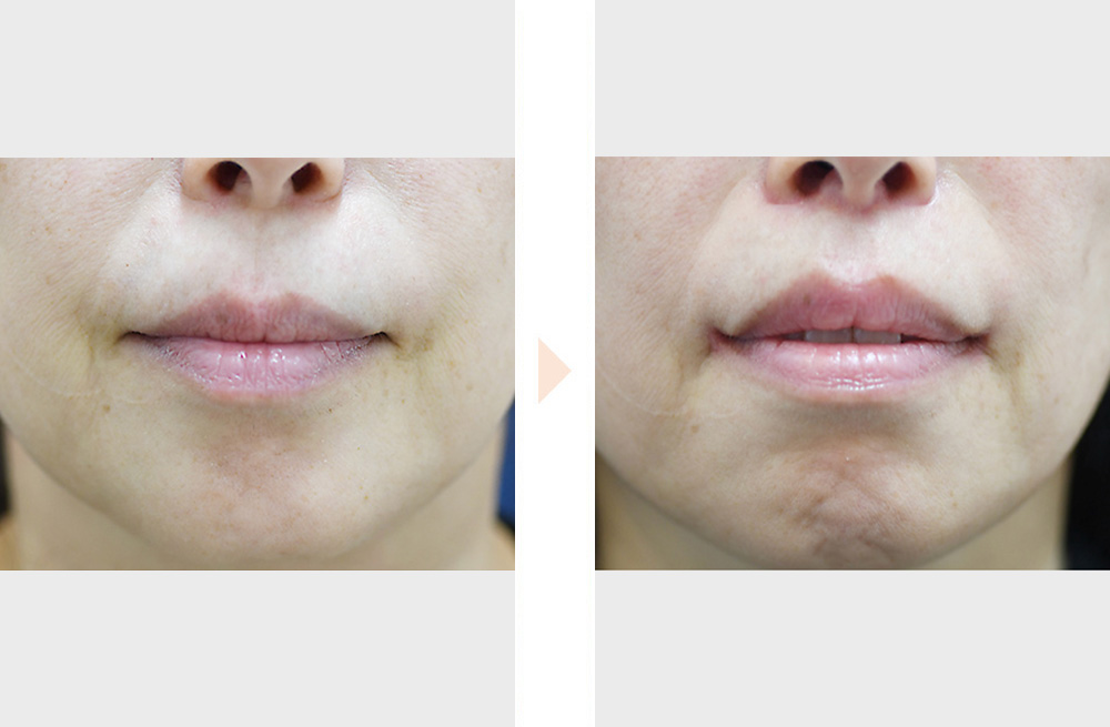 人中短縮・口角挙上（皮膚切開法／傷跡改善ボトックス併用）の症例写真・ビフォーアフター