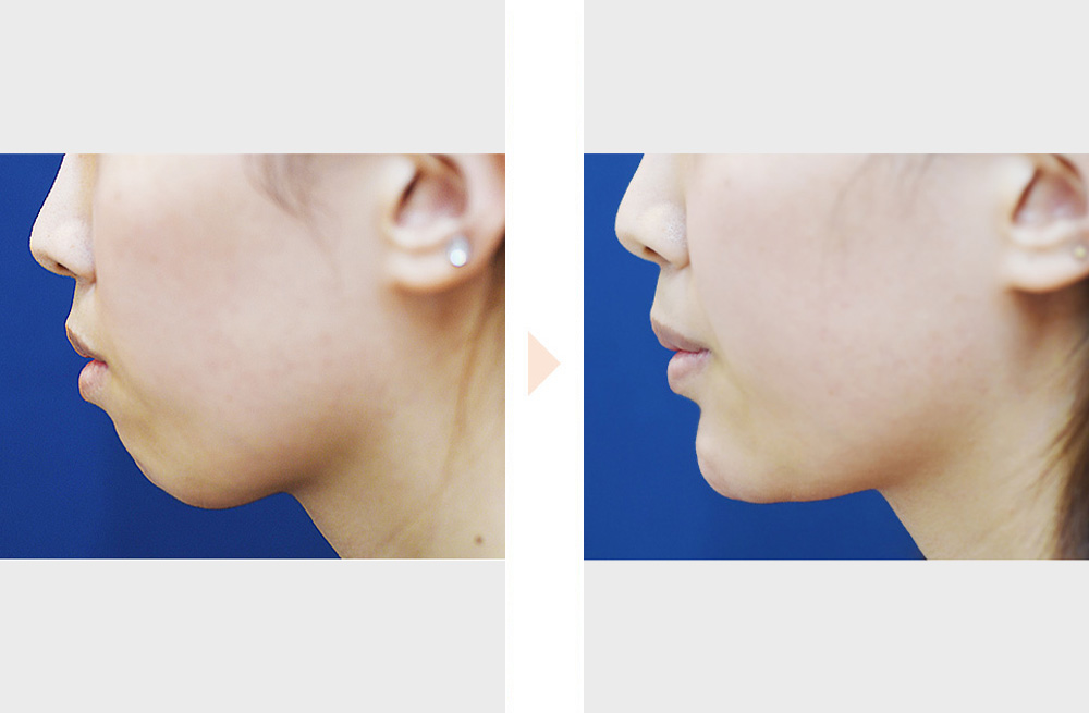 顎プロテーゼ（手術なし・Eライン形成）の症例写真・ビフォーアフター