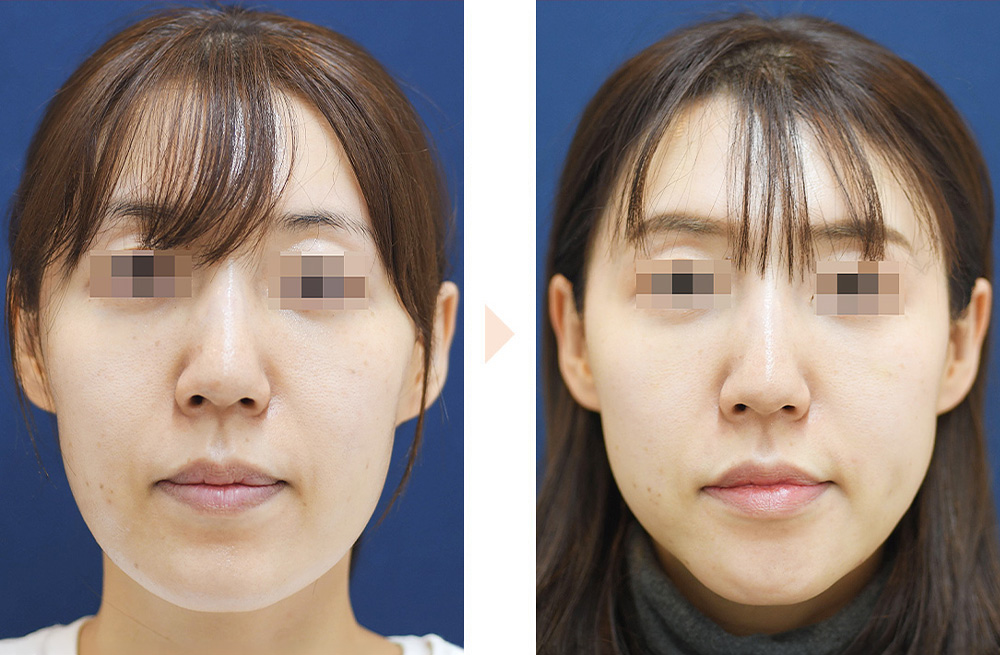 Vライン形成（U字型の大きな顎の改善）の症例写真・ビフォーアフター