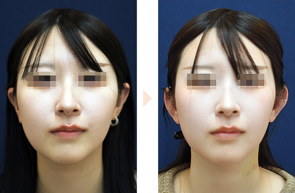 立ち耳整形・耳起こし（耳珠軟骨移植あり）の症例写真・ビフォーアフター