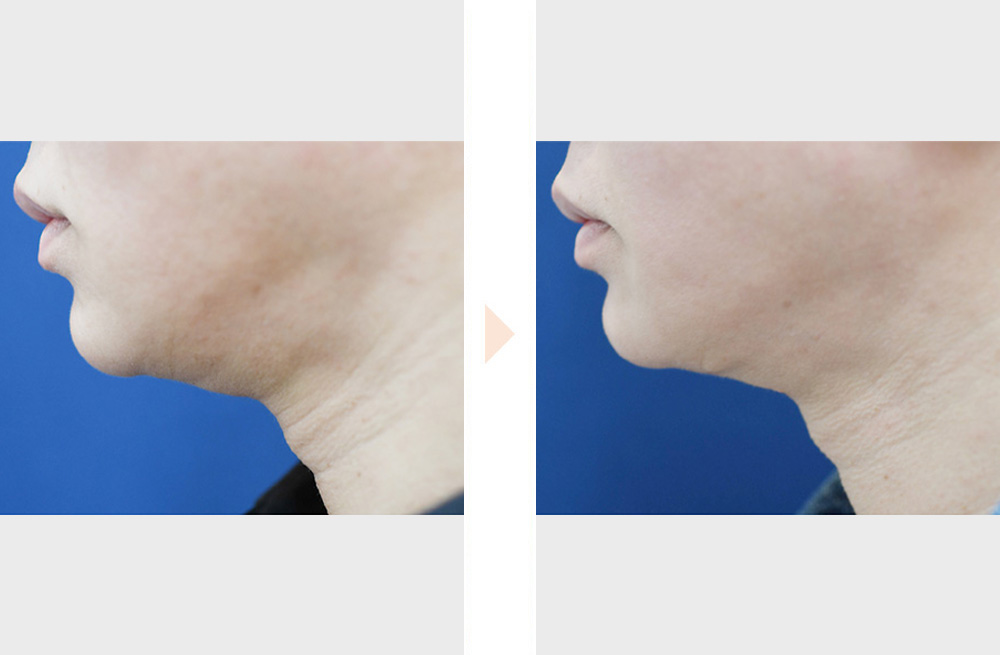 ペリカン手術（他院で実施した脂肪吸引後の修正）の症例写真・ビフォーアフター