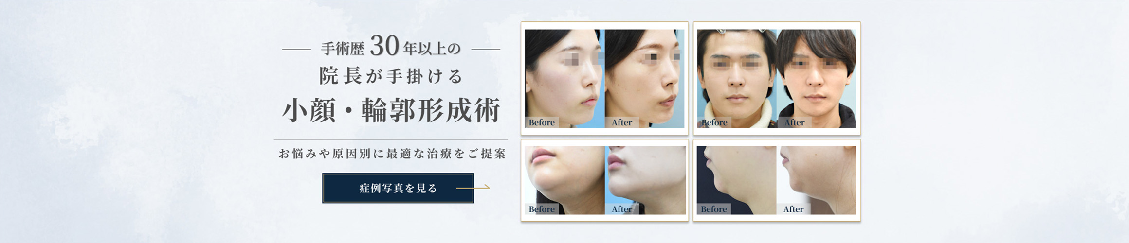 小顔・輪郭形成