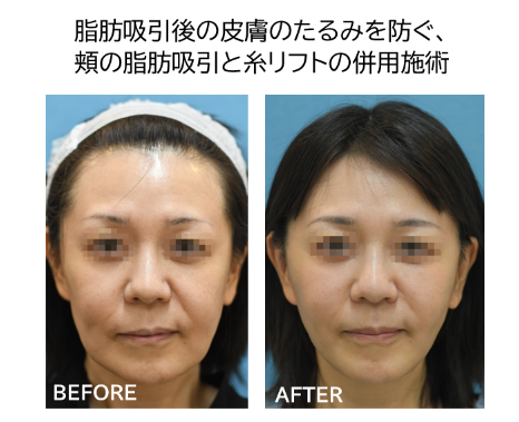 40代以上の脂肪吸引症例