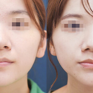 ジョールファット除去による小顔・Vライン形成