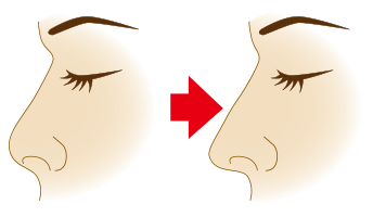 鼻中隔延長法